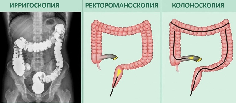 Диагностика функциональных нарушений кишечника