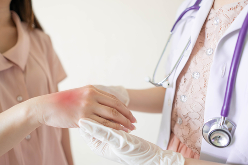 Обратиться к терапевту с ожогом