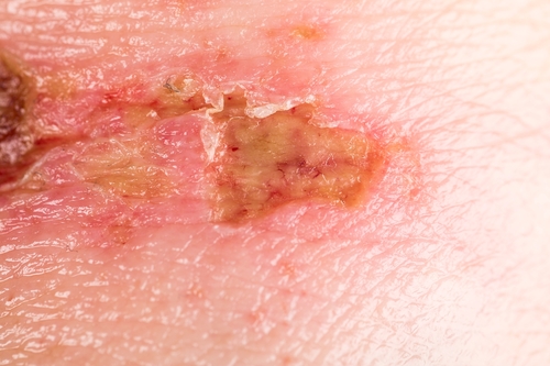 Виды ожогов