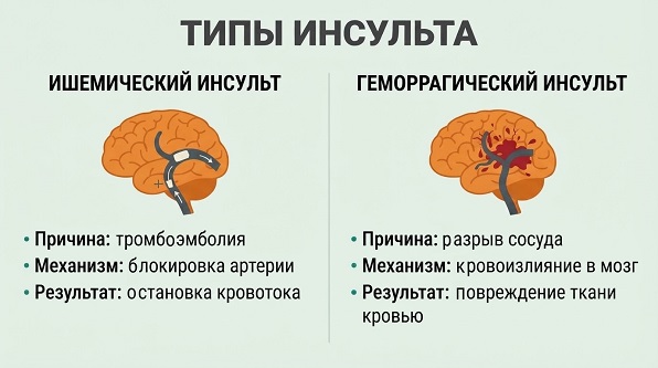 Виды инсульта